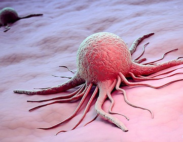 Đa polyp túi mật có nguy hiểm không? - Ảnh 2.
