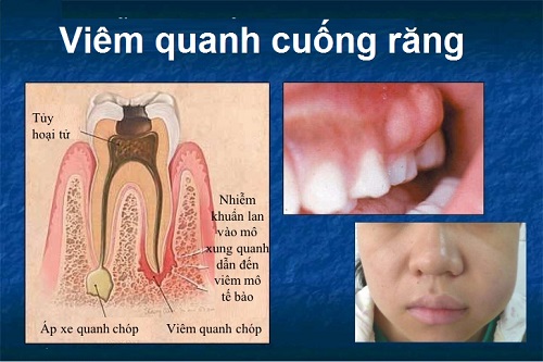 Viêm quanh cuống răng: Hệ quả của thói quen xấu VQC5