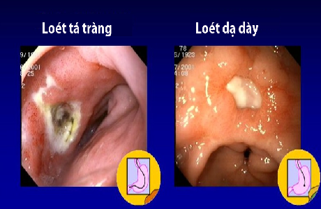 Trị viêm loét dạ dày - hành tá tràng có dễ?