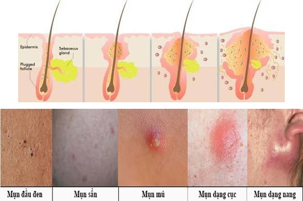 Các dạng mụn trứng cá do dùng corticoid.