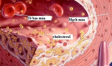 Các cholesterol trong lòng mạch máu ở người mỡ máu.