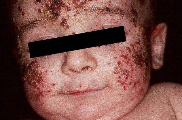 Owen Richards (7 tuổi) bị eczema với nhiều vết xước rỉ máu.