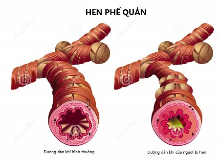 Hen phế quản