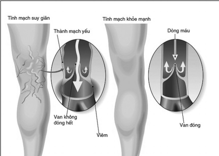 Hình ảnh suy giãn tĩnh mạch Hình ảnh suy giãn tĩnh mạch