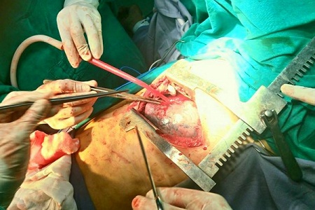 Ca phẫu thuật cứu sống bệnh nhân
