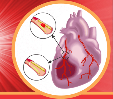 Nhồi máu cơ tim