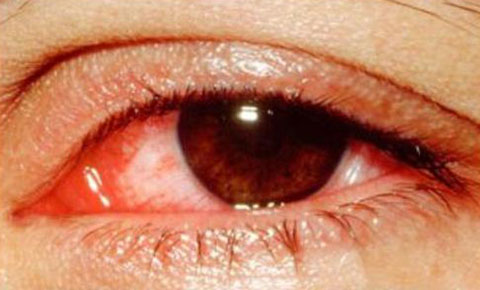 Viêm kết mạc (đau mắt đỏ)