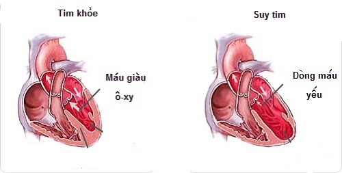 Suy tim - một tác dụng phụ khi dùng thuốc chứa saxagliptin.