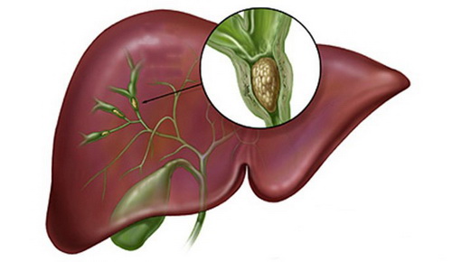 Sỏi đường mật trong gan.