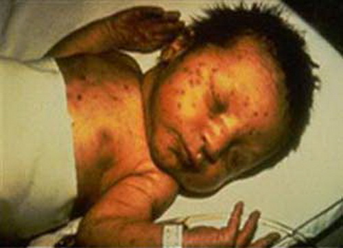 Tổn thương da do hội chứng Rubella.