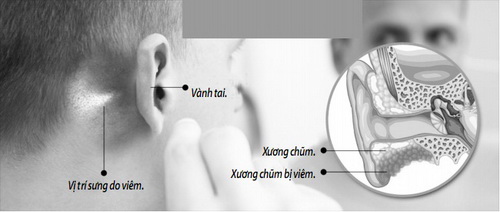 Thuốc trị viêm tai xương chũm