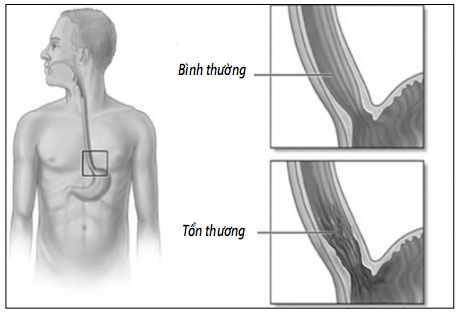 Thực quản bình thường và thực quản bị tổn thương.