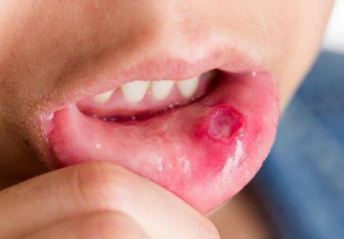 Tổn thương trong bệnh viêm loét niêm mạc miệng.
