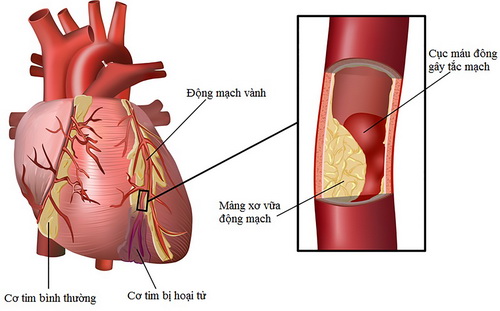Tăng triglycerid máu làm tăng nguy cơ mắc bệnh mạch vành, dễ dẫn đến tắc nghẽn động mạch.