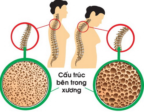 Cần tuân thủ chỉ định dùng thuốc của bác sĩ xương khớp trong trị bệnh loãng xương.