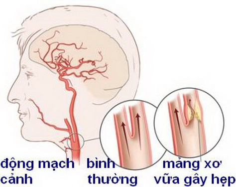 Động mạch cảnh bị hẹp là do mảng vữa xơ phát triển dày lên từ thành mạch.