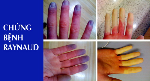 bệnh Raynaud