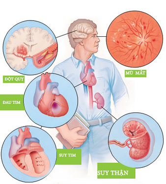 Tăng huyết áp gây nhiều hệ lụy cho sức khỏe.
