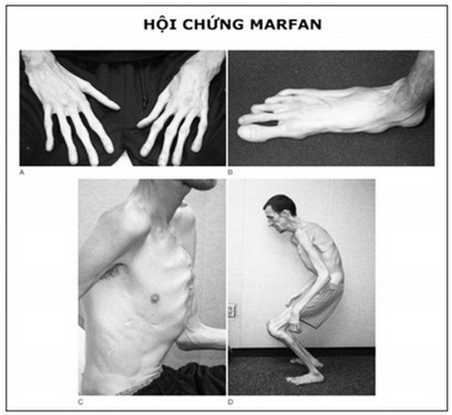 hội chứng Marfan