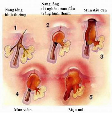 Hình ảnh mụn trứng cá đỏ.