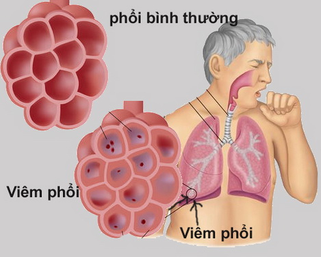 Người bị bệnh ở phổi thường có biểu hiện ho, tức ngực, khó thở…