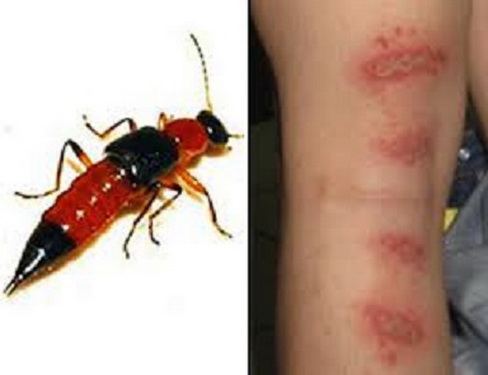 Không nên di, miết để giết kiến ba khoang vì có thể gây bỏng cho vùng da tiếp xúc.