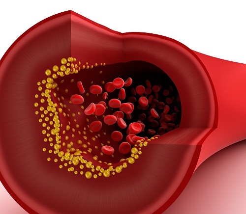 Cách ngăn ngừa và trị rối loạn lipid máu