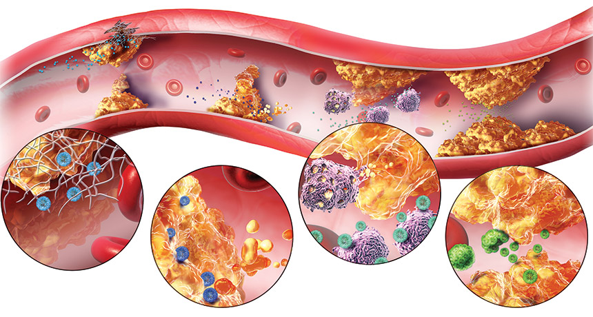 Các phân tử lipid khi đi vào mạch máu sẽ làm tắc nghẽn và gây xơ vữa động mạch.