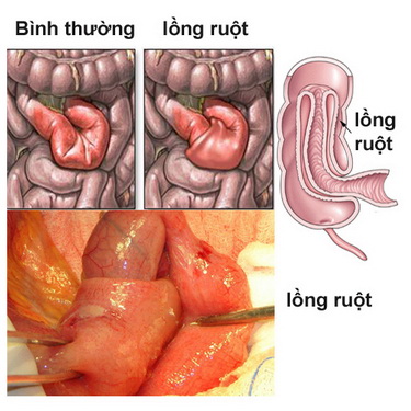 Lồng ruột - một nguyên nhân gây nôn trớ ở trẻ.