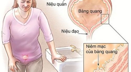 Đa số sỏi bàng quang gây đái dắt nhiều, đau bụng dưới...