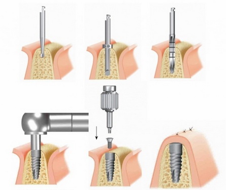 Quá trình cấy Implant nha khoa.