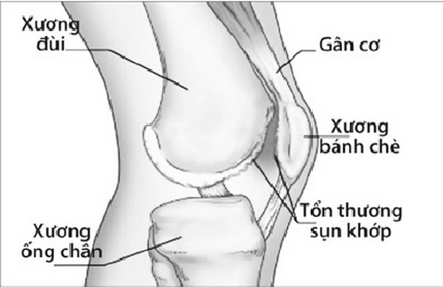 Tổn thương sụn khớp do thuốc.