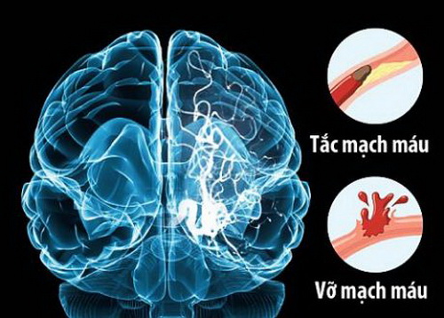 Xơ vữa mạch máu, huyết khối gây bít tắc lòng mạch đều có thể gây tai biến mạch máu não.