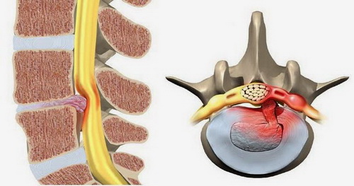 Thoát vị đĩa đệm cột sống, một nguyên nhân gây đau lưng.