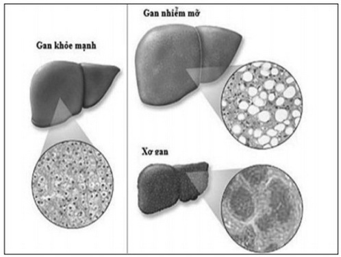 Những người béo bụng dễ mắc gan nhiễm mỡ.