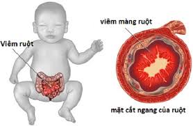 Cần xét nghiệm cận lâm sàng để xác định về tổn thương đường ruột như: nội soi, sinh thiết, xét nghiệm phân,...