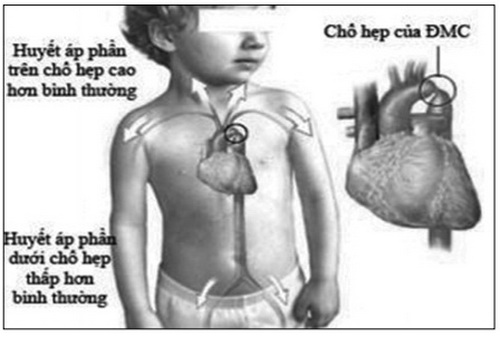 Cần phải nghĩ đến hẹp eo động mạch chủ trên trẻ có tăng huyết áp.