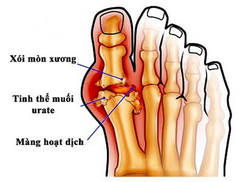 Biểu hiện bệnh gút ở bàn chân.