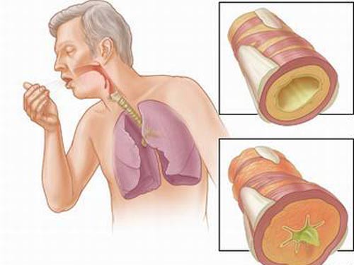 Cần xác định nguyên nhân gây ho để dùng thuốc phù hợp.