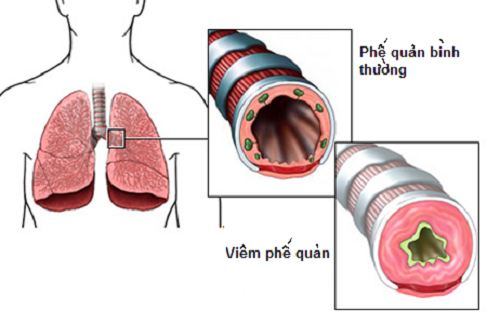 Viêm phế quản - một nguyên nhân gây ho.