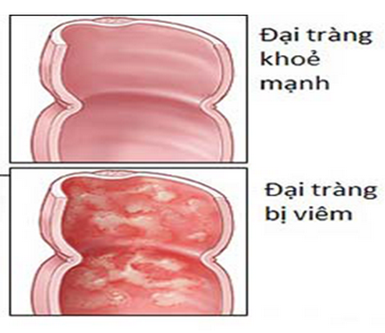 Hình ảnh đại tràng bị viêm.