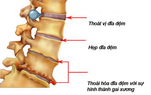 Thoát vị đĩa đệm cột sống thắt lưng - một nguyên nhân gây đau lưng.