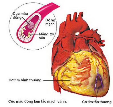 Hút thuốc thời gian dài gây tổn thương lớp nội mạc mạch máu, dẫn tới  sự co thắt mạn tính cho mạch máu, khiến cơ tim bị tổn thương.