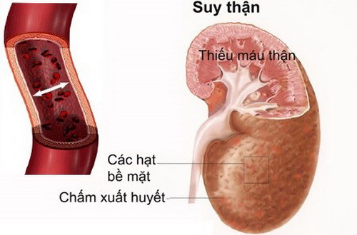 Các thuốc gây thiếu máu thận kéo dài dễ gây suy thận.