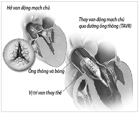 Bệnh tim mạch và những điều quan trọng bạn cần biết  Hello Bacsi