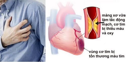 Xơ vữa mạch vành khiến lượng máu đến tim giảm.