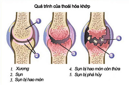 Thoái hóa khớp gặp chủ yếu từ lứa tuổi trung nên trở lên.