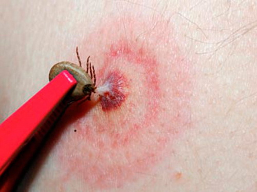 Virus Bourbon lây lan qua một loại côn trùng. Virus Bourbon lây lan qua một loại côn trùng.
