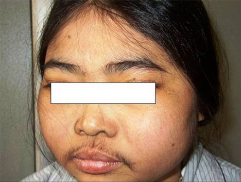 Bệnh nhân bị hội chứng Cushing và mọc râu do lạm dụng corticoid.