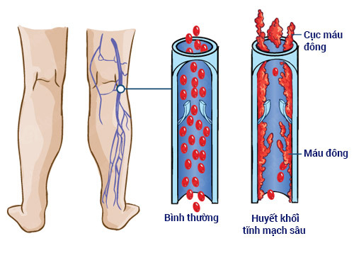 Nhồi máu phổi thường do huyết khối hình thành trong các tĩnh mạch sâu ở chi dưới di chuyển lên.